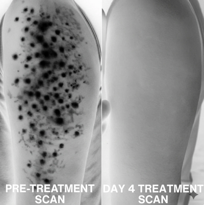 Advanced Triple-Acid Complex for Keratosis Pilaris