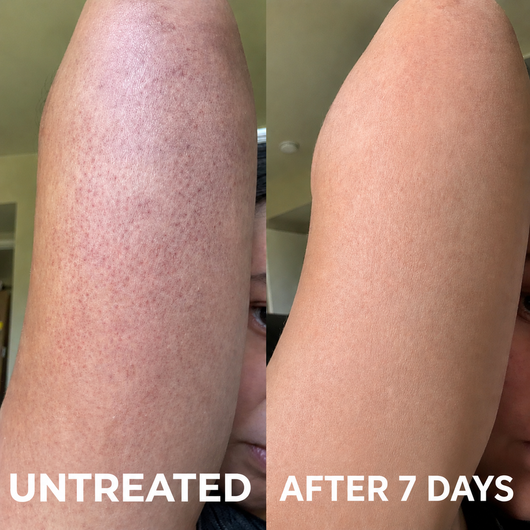 Advanced Triple-Acid Complex for Keratosis Pilaris