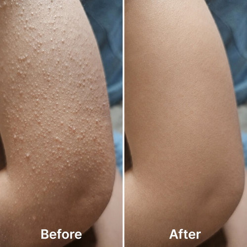 Advanced Triple-Acid Complex for Keratosis Pilaris