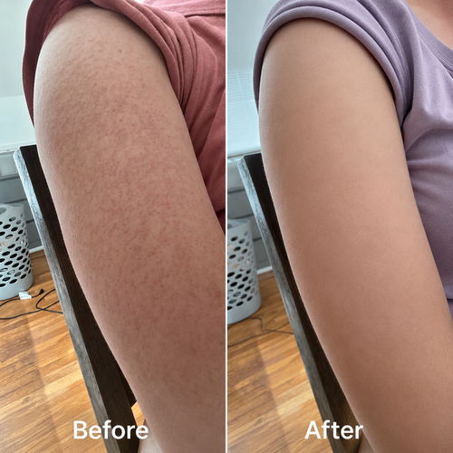 Advanced Triple-Acid Complex for Keratosis Pilaris